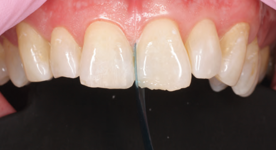 Direct Build-Up After Dental Trauma Using Ecosite Elements Composite Material | Max-Richard Seidemann